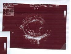 HCM ultrasound scan picture
